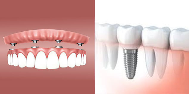 Dental Implants