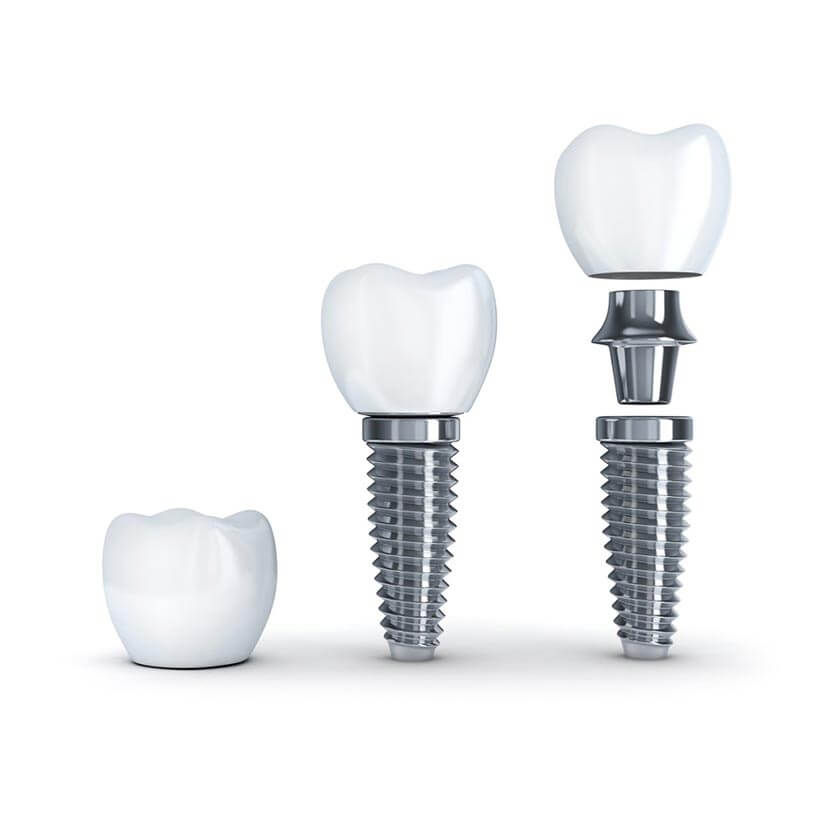Dental Implants in Roseville, CA Offering Free Consultations