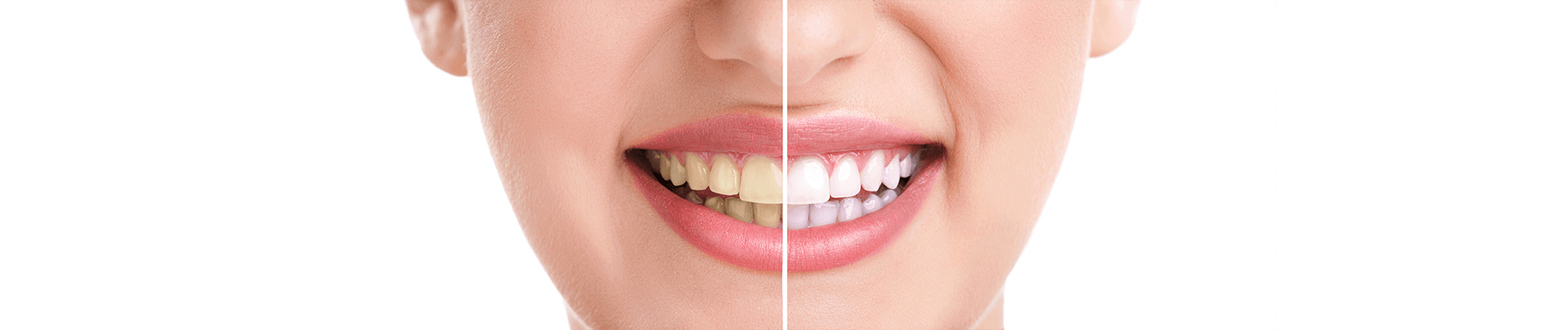 Teeth Whitening